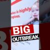 Measles Outbreak 🤒