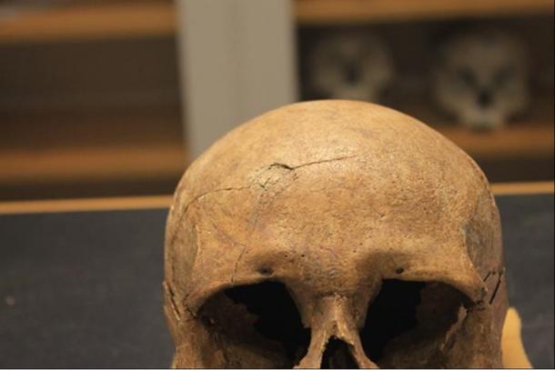 From the Viking skeletal study: A skull displaying blunt force trauma with radiating lines.