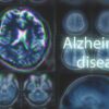 Brain scans labeled Alzheimers disease background