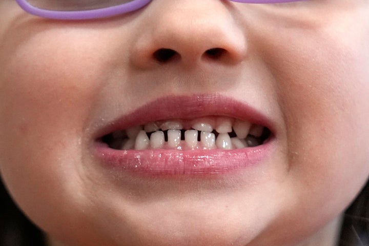 A child shows off her teeth after a dental exam in Concord, N.H., in this 2024 file photo. (AP Photo/Robert F. Bukaty, file)