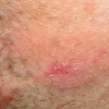 "Extramammary Paget’s disease (EMPD) is a rare skin cancer that often appears as a scaly, itchy, or red patch in the genital or anal areas," the author writes. "Often mistaken for other conditions, it typically grows slowly but can become invasive."