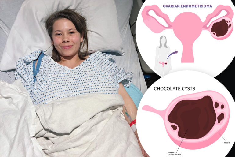 Gossip & rumors: what is a chocolate cyst? bindi irwin