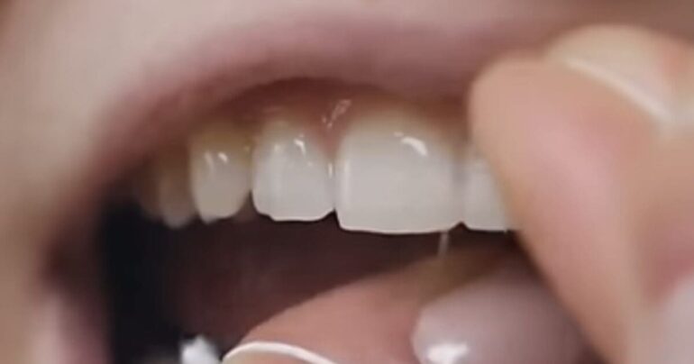 NIH Says Vaccines Delivered By Dental Floss Might Be "Promising" * 100PercentFedUp.com * by Danielle