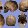 Skull 2N showing evidence of rare Apert syndrome.