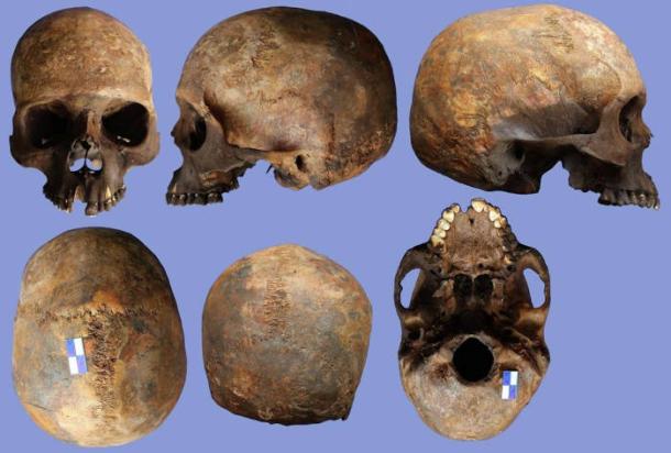Skull 2N showing evidence of rare Apert syndrome.