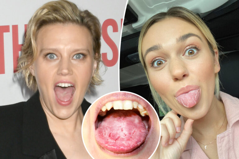 Gossip & rumors: what is 'geographic tongue'? all about 'snl'