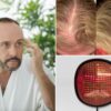 Science & tech: does red ligh therapy for hair loss
