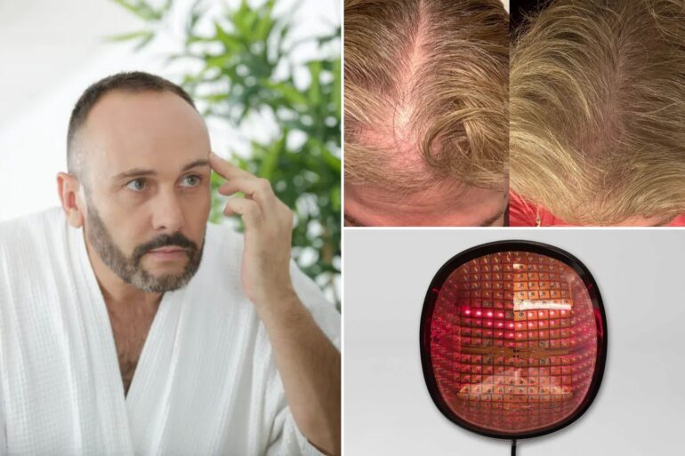 Science & tech: does red ligh therapy for hair loss