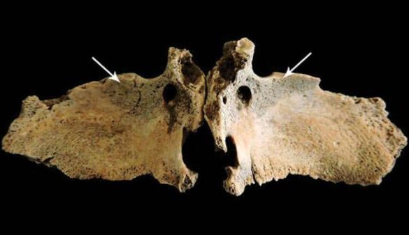 New bone on the greater wings of the sphenoid bone, suggestive of vitamin C deficiency in Roman Briton.
