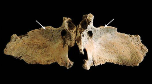 New bone on the greater wings of the sphenoid bone, suggestive of vitamin C deficiency in Roman Briton.