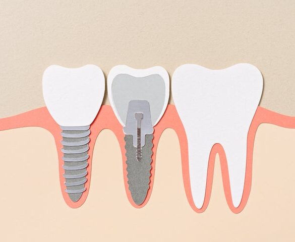 If you must eat before an appointment, try to time it at least one hour before your cleaning.