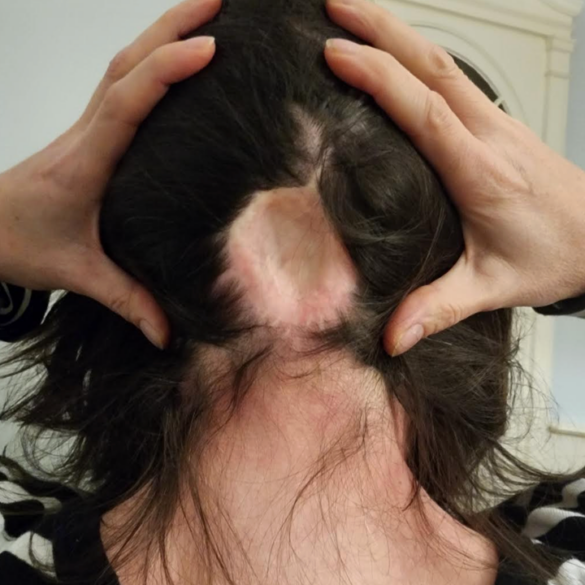 This is the photo that the author submitted to accompany her melanoma community profile. It was the first time she ever photographed her scar.