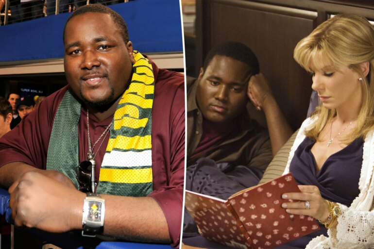 GOSSIP & RUMORS: Rare cyst found on 'The Blind Side'