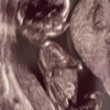 An ultrasound photo of the author's daughter at 12 weeks gestation.