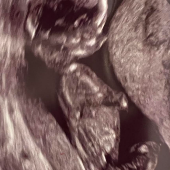 An ultrasound photo of the author's daughter at 12 weeks gestation.