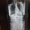 An X-ray of the author's spine taken in 2023.